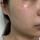 더시원마취통증의학과의원 | 대구 신세계가정의학과의원 점, 쥐젖, 편평사마귀, 주근깨제거 후기 (내돈내산)