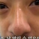 11650-7-4-1 | 부산 서면 눈밑지방재배치 수술 4-7일차(1주일차) 후기, 눈 밑 꺼짐 전후사진O