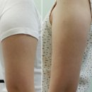 S메디칼약국 | 내돈내산 팔뚝 부유방 견갑 지방흡입 수술 당일 직후 리얼후기 1탄