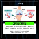 김포정형외과추천 계단 오르내리기가 불편한 무릎통증, 십자인대파열 이미지