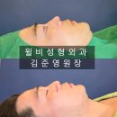 김준영 | 남자 무보형물 코수술 직후 후기 [윌비성형외과 김준영 원장]