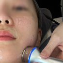 라임식품 | 신사역피부과에서 새해 첫피부과시술 _ 울쎄라피프라임 100샷 후기 (통증,붓기,관리,부작용 찐후기)