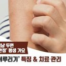 어루러기 원인 어루러기 전염 연고 이미지