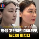리터닝성형외과의원 | 매부리 코성형후기｜컴플렉스 교정으로 자신감 되찾은 환자 사례 ㅣ리터닝성형외과