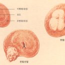 전립선비대증 수술 후기 - 펌 - 이미지