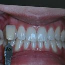 치아사랑치과의원 | 신사역 레브치과의원 치아미백, 스케일링 내돈내산 후기