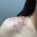 사라한의원 | 건대윤곽관리 한여울에스테틱 건대점 파워리프팅 받으러 가서 어깨 고치고 온 후기