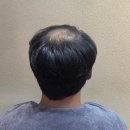 원호암5길 | <충주> 부분 가발 시술 하는곳 추천 후기 (두피미학본점)