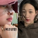 치유성형외과의원 | 복코성형 뭉툭한 코끝, 구조부터 바로잡아! (강남성형외과)