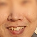 뉴엔치과의원 | 내돈내산 제로네이트 후기 강남 뉴엔 치과 의원