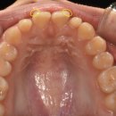 라인아치 치과기공소 | 신림역치과 앞니 왜소치, 라미네이트 무삭제로 가능할까?