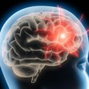 흔한 두통, 시력 감퇴?...뇌종양 의심 증세 이미지