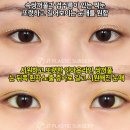 제이티플랜 | 자연유착쌍꺼풀과 뒷트임 수술 전후사진 (제이티성형외과)