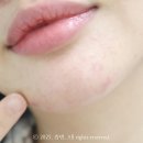 동화제 | 약국 여드름 연고 닥터 예스키놀 젤 후기 가격부터 효능 효과까지 솔직 리뷰