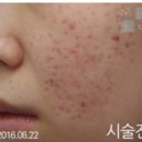 손톱흉터 점뺀흉터 피부재생력부터 복구시키는 로담한의원