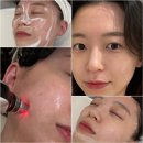 윤스피부미용 | 광명 피부관리 윤스뷰티 바쿠나 pp앰플 MTS+EMS 여드름관리
