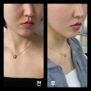 신논현역 피부과 리쥬란힐러 4cc 효과 7일차 후기, 손주사로 엠보싱 잘 나오는 곳 ( 인젝터 VS 손주사 )