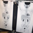 관해로 | [항암3-1 회차 후기]호지킨 림프종 3기, 중간검사 '완전 관해' 판정