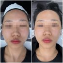 셀레나 | 마산윤곽관리 ‘셀레나뷰티’ - 페이스핏톡스 후기