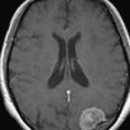 양성 뇌수막종양.....임상학적 진단으로 보험금청구권리의 재발견...... 이미지