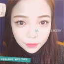 잘하는성형외과 Daum카페