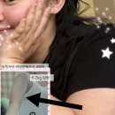 즐거운 다이어트 생활체조 | 수원다이어트병원, 4회차 팔뚝 지방분해주사효과