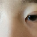 제이더블유(JW)정원성형외과의원 | 중학생 쌍수 강남 4군데 병원상담 및 쌍수 앞트임 수술 후기