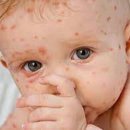 # 풍진 _ 풍진 風疹 (Rubella virus) 루벨라 바이러스 원인 및 증상 치료 방법 후기 일지 기록