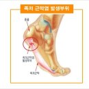 발바닥 통증의 원인 족저 근막염과 ﻿﻿발바닥 통증 종류 이미지