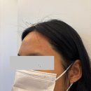 썬헤어라인 | 부천 첫 헤어라인왁싱후기 / 내몸에슈가 부천시청점