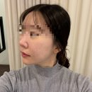 실로 지방재배치 한다? 실루엣소프트 밸런스 리프팅 후기