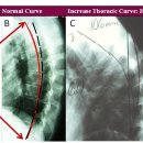 척추후만증(Kyphosis) 이미지