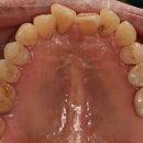 엔도코어 이미지