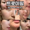 딜리스미에스테틱 | 트로이필 관리 후 9일차 기록, 비포애프터 추천 후기