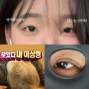 멍택시 | 한쪽눈 쌍수 짝눈 자연유착 당일부터 3일차 후기 붓기, 멍