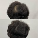 에센셜스튜디오 SMP | 원흥 머리빠짐 관리 잘 하는 곳, 에센셜스튜디오 추천