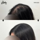 레이븐스칼프 | 대구두피문신 첫도전 성공