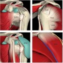 회전근어깨파열증상 방치하면 극심한 통증 이미지