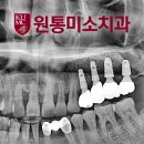 원통미소치과의원 네이버블로그