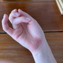 땡큐에브리원 | 🇹🇭푸켓에서 응급 진료받은 후기 카카오페이여행자보험