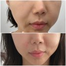 청담쥬넥스피부과의원 | 압구정로데오피부과 셀리크의원 팔자주름 셀리쥬 자가진피재생술 찐후기