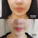 세안안전진단 | 수원 인계동피부과 티타늄리프팅+슬림핏주사 제대로 받고 온 후기