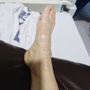 무지외반증 수술 9개월 나사제거, 철심제거, 핀제거 수술 후기 2편