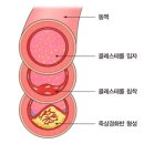 죽상경화증[Atherosclerosis]순환기질환 이미지