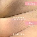 울산 삼산동 바디색소침착 르멜라 멜라닌 케어 2탄:: 한방에 겨드랑이 색소제거 성공