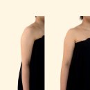 아로아로 | 대전 웨딩관리 잘하는 곳 아로뮤에스테틱 팔뚝 관리 후기