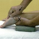 (치료)subtalar joint gliding mobilization 이미지