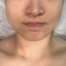구미상모피부관리 [혜늘뷰티] 실리프팅 후기