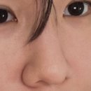 달코 | 콧볼 보톡스 효과 있을까?｜전후 변화, 코조각주사 한달차 후기 (내돈내산)