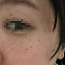 고창제일가정의학과의원 | 대구 신세계가정의학과 편평사마귀 제거 비용 및 후기(1)